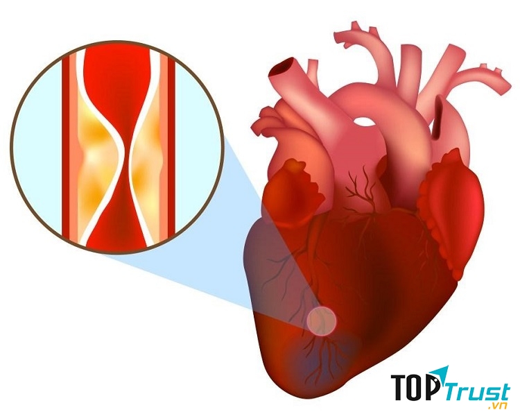 Nhồi máu cơ tim xảy ra là do mạch vành bị tắc nghẽn bởi cục máu đông