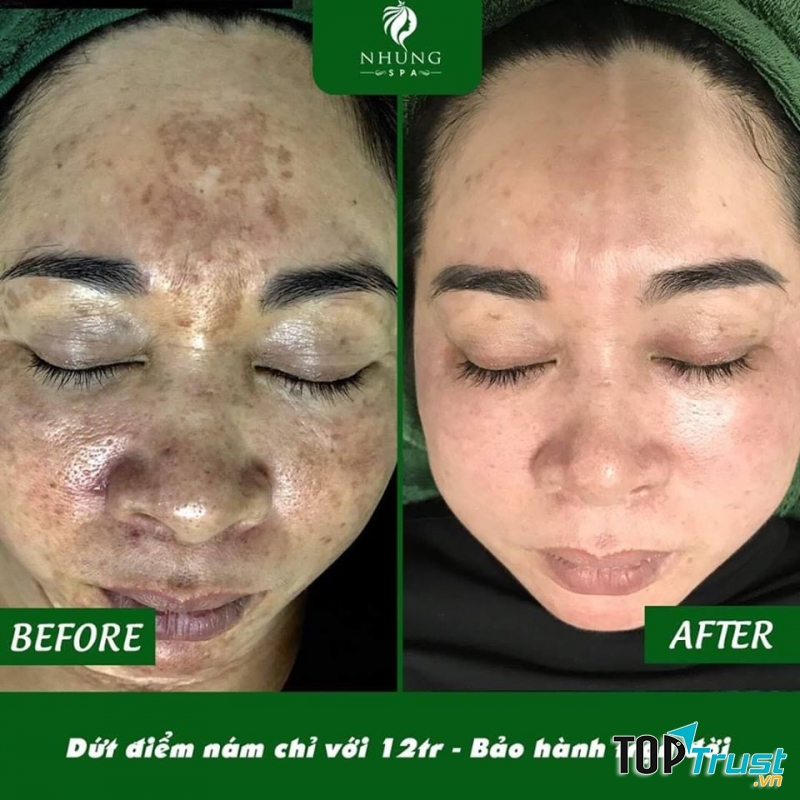 Nhung Spa chuyên trị nám và tàn nhang cho khách tại Hà Nam