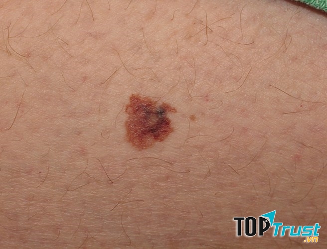 Đó có thể là dấu hiệu của bệnh ung thư da hoặc xuất hiện một khối u ác tính trên da
