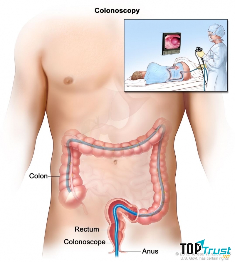 Cần nội soi đại tràng