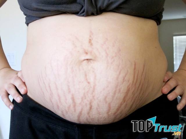 Nước cốt chanh và bơ ca cao trị rạn da rất hiệu quả