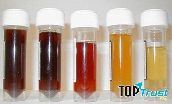 Màu sắc của nước tiểu cũng là dấu hiệu phản ảnh tình trạng sức khỏe của bạn.