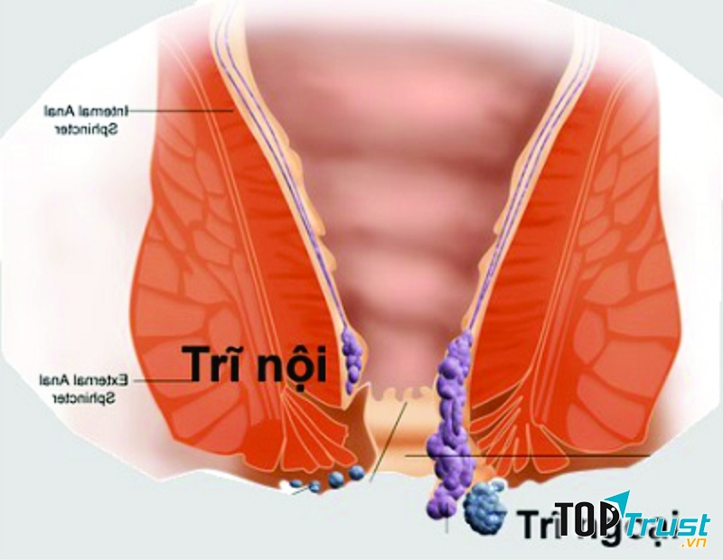 Khi đi ngoài mà phân có máu bạn cũng nên lưu ý, có thể là bệnh trĩ hoặc một cái gì đó vô hại do đi ngoài khó gây rách hậu môn nhưng cũng có thể là dấu hiệu ung thư ruột kết