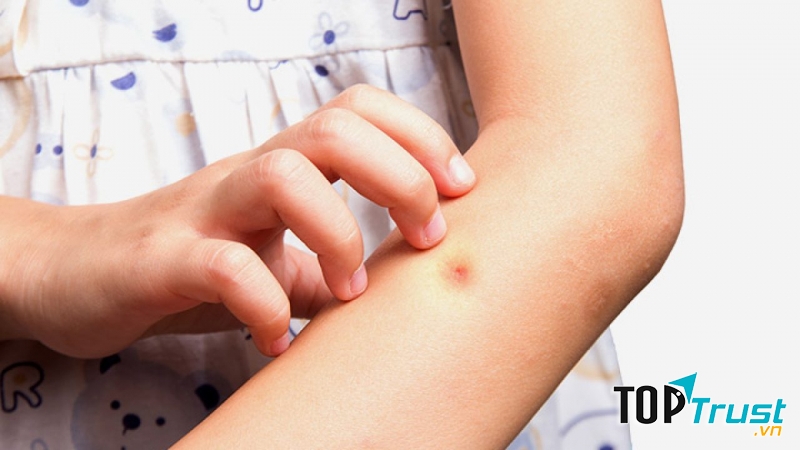 Phòng chống muỗi đốt