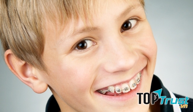 Chỉnh răng cho trẻ