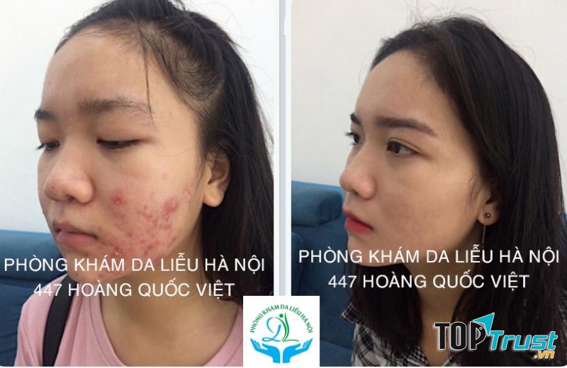 Phòng Khám Da Liễu Trị Mụn Hà Nội