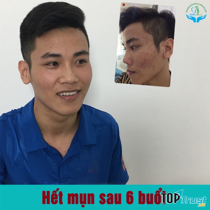 Phòng Khám Da Liễu Trị Mụn Hà Nội
