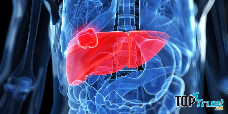 Tỏi có tác dụng phòng ngừa cũng như hỗ trợ điều trị ung thư dạ dày, ung thư gan,...