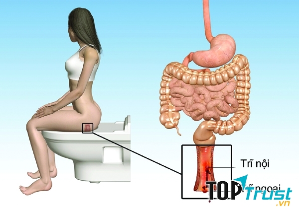 Một lý do hàng đầu dẫn đến bệnh trĩ ở phụ nữ chính là công việc văn phòng ngồi nhiều giờ liền liên tục.