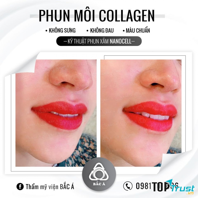 Phun môi collagen tại Bắc Á Cần Thơ