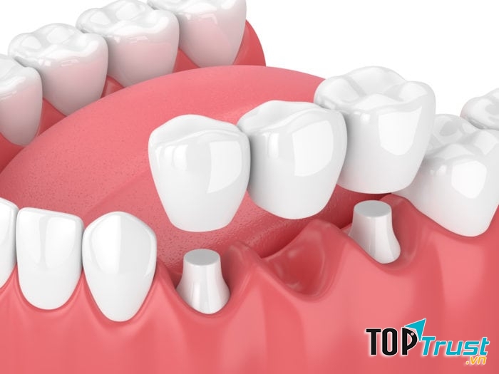 Răng thật kế cận răng đã mất được mài để làm cầu răng sứ