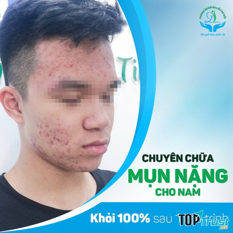 Điều trị mụn tại Phòng Khám Da Liễu Hà Nội, cam kết khỏi 100% sau 1 liệu trình