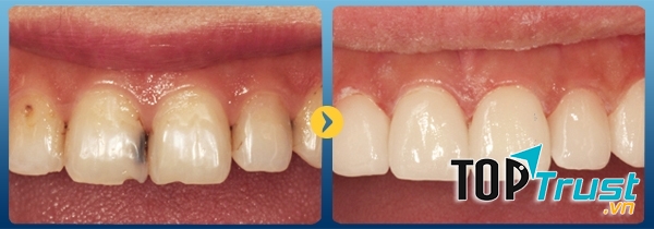 Kết quả hàn trám răng tại Răng hàm mặt quốc tế Sài Gòn