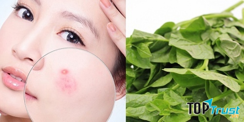 Bạn có thể dùng mồng tơi giã nát và đắp trực tiếp lên vùng da có mụn