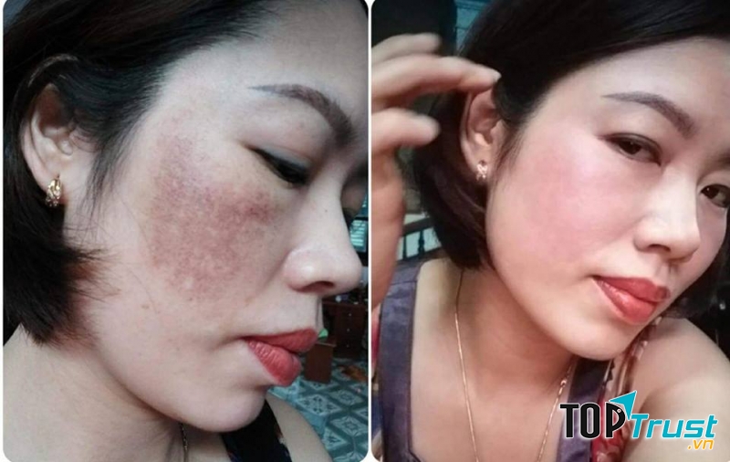 Kết quả mỹ mãn của khách hàng thực hiện liệu trình trị nám tại Thẩm mỹ Rio