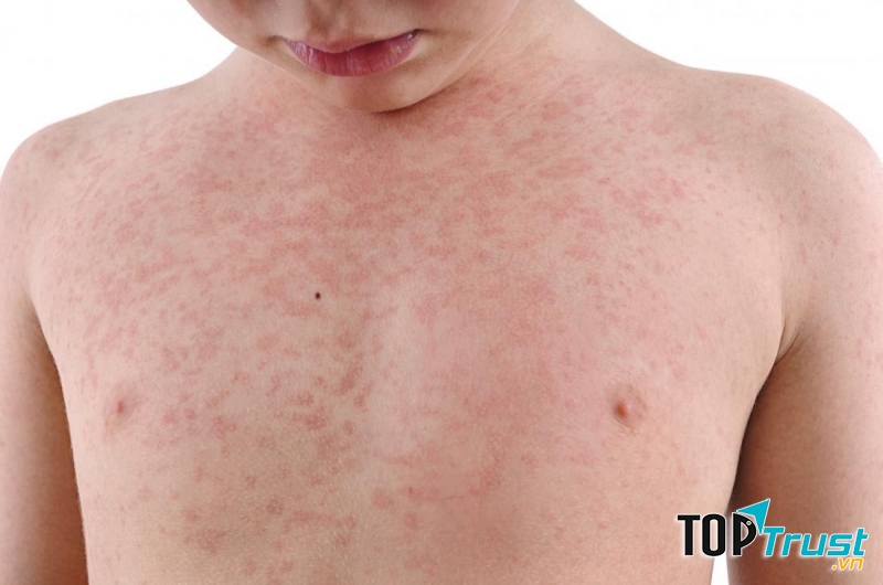 Rubella