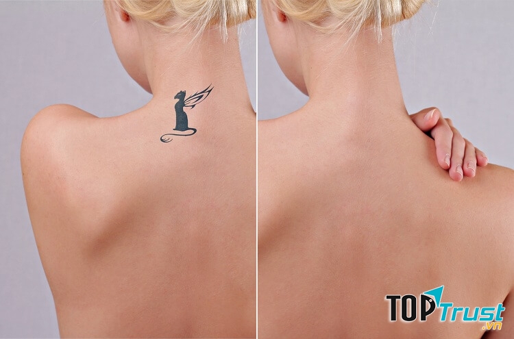 Trước và sau khi sử dụng công nghệ  Laser Revlite tại Saigon Smile Spa