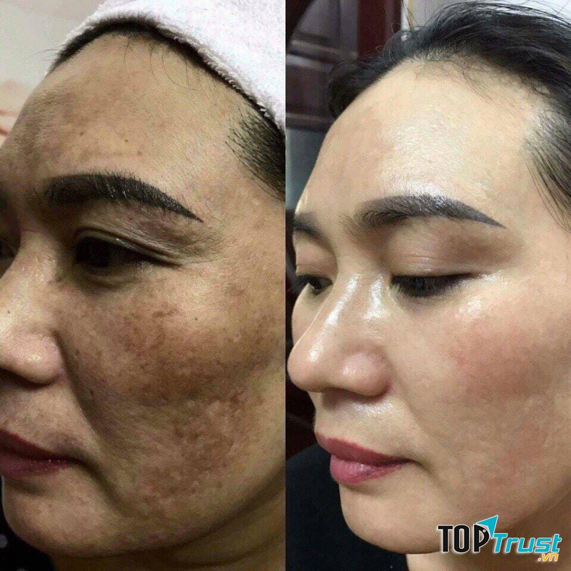 Trị nám tại Sam Sam Beauty