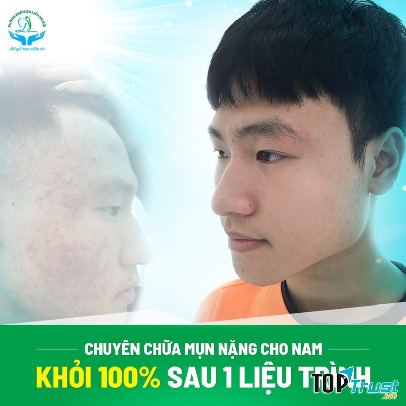 Điều trị mụn tại Phòng Khám Da Liễu Hà Nội