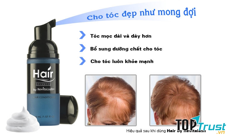 kích thích sự phát triển của tóc tại những vùng da đầu không mọc tóc hoặc tóc thưa, ngăn ngừa rụng tóc, đem lại cho bạn một mái tóc dày bóng, chắc khoẻ, mềm mượt.