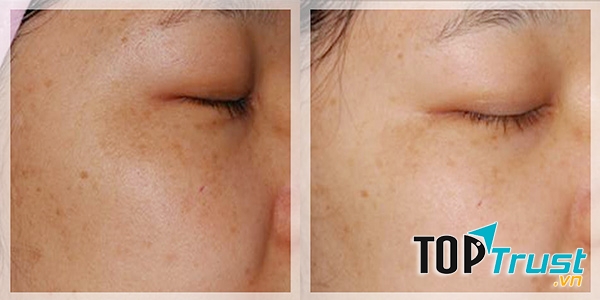 Hiệu quả rõ nét khi dùng Serum trị nám Murad Advanced Active Radiance