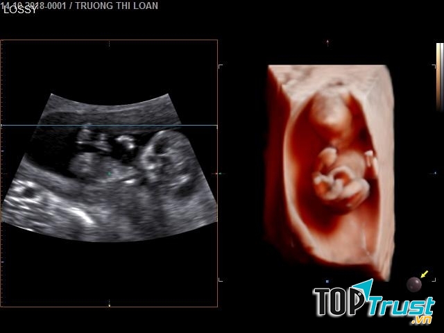 SIÊU ÂM 5D - PGS Nguyễn Phước Bảo Quân