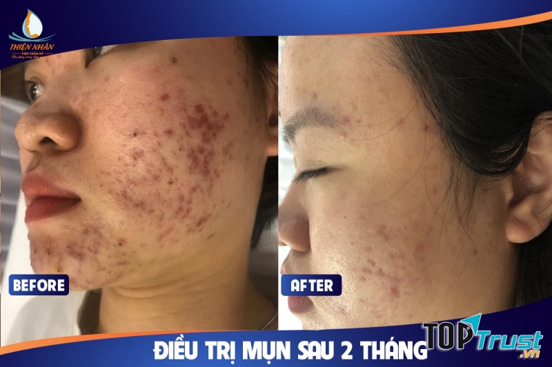 Kết quả từ khách hàng sau khi điều trị mụn tại Skincare Viện thẩm mỹ Thiện Nhân