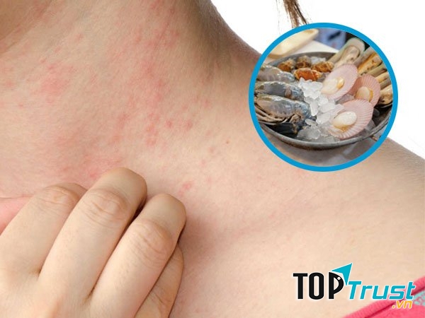 Ăn sò huyết gây dị ứng