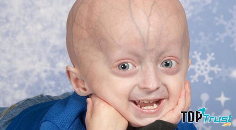 Bệnh lão hóa sớm