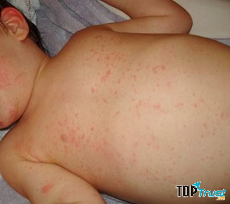 Sốt phát ban gây mẩn đỏ khắp người trẻ.