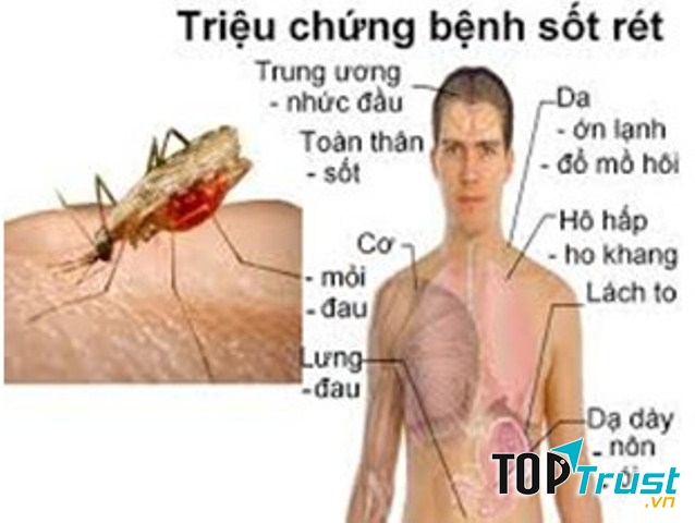 Sốt rét - Nguồn Internet