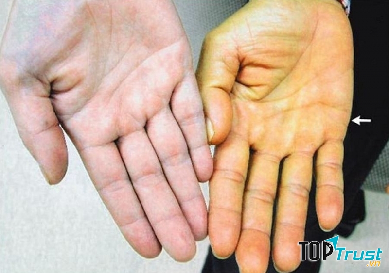 Sốt vàng da - Nguồn Internet