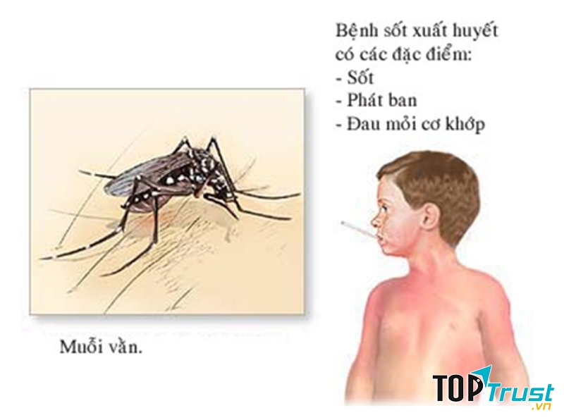 Sốt xuất huyết