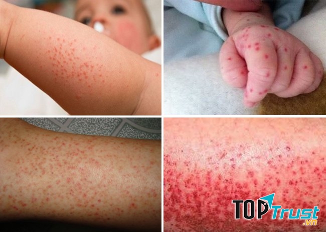 Biểu hiện của bệnh sốt xuất huyết