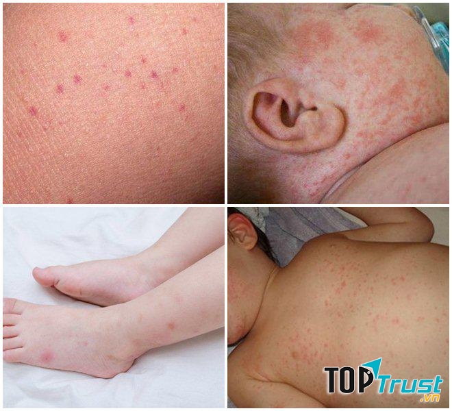 Sốt xuất huyết ở trẻ nhỏ