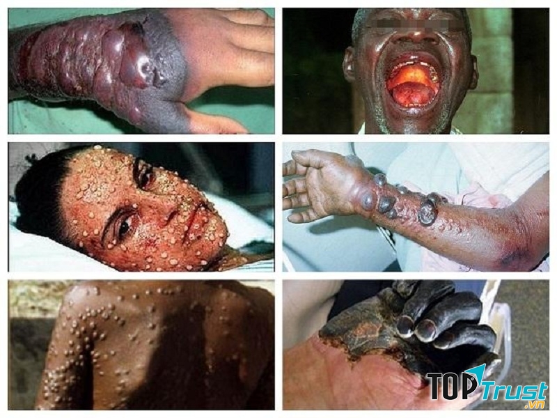 Sốt xuất huyết Ebola