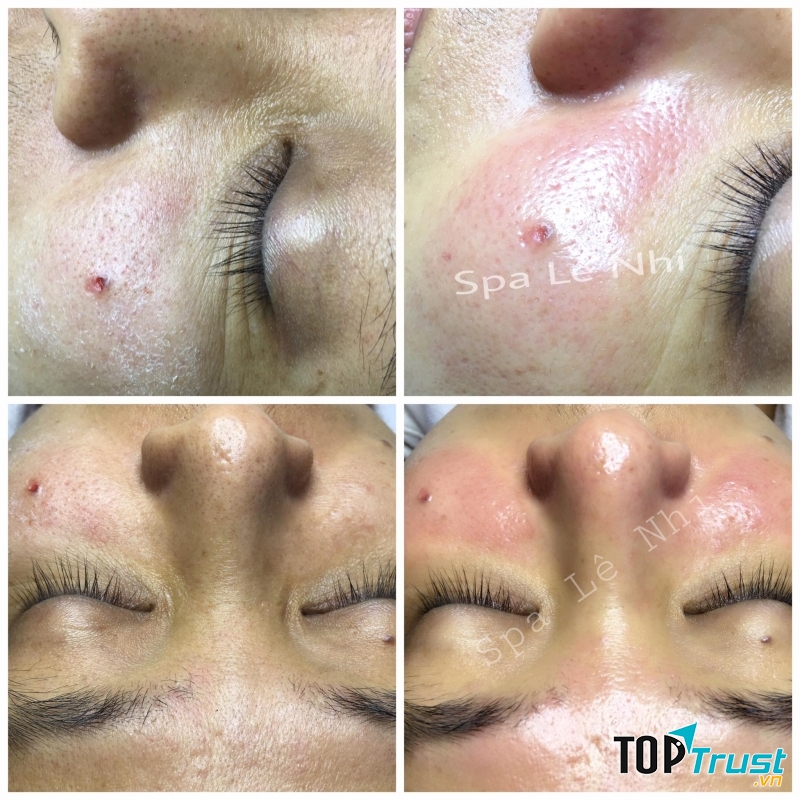 Trị mụn đầu đen tại Spa Đông Y Lê Nhi