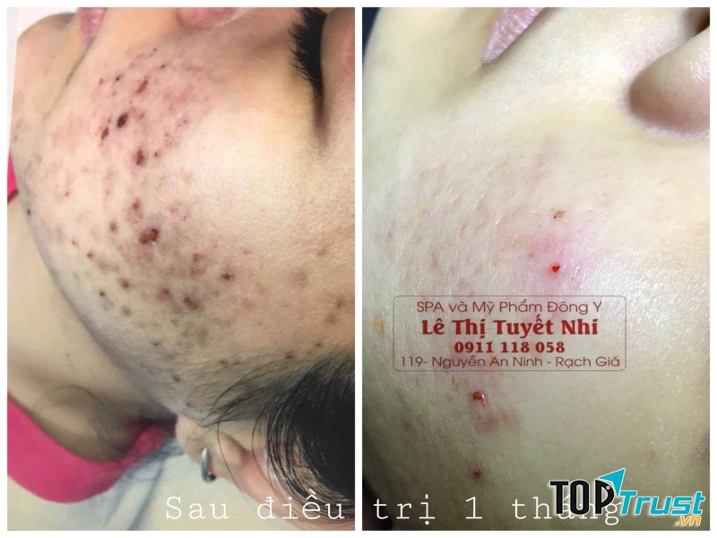 Điều trị mụn tại Spa Đông Y Lê Nhi