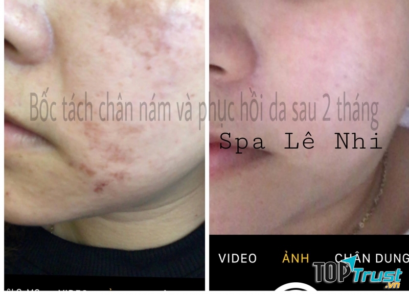 Bốc tách chân nám và phục hồi da sau 2 tháng tại Spa Lê Nhi