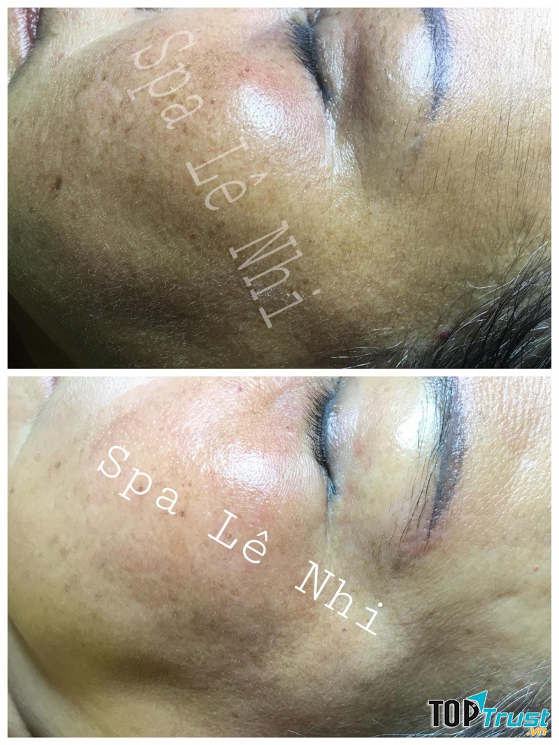 Trẻ hóa da tại Spa Đông Y Lê Nhi