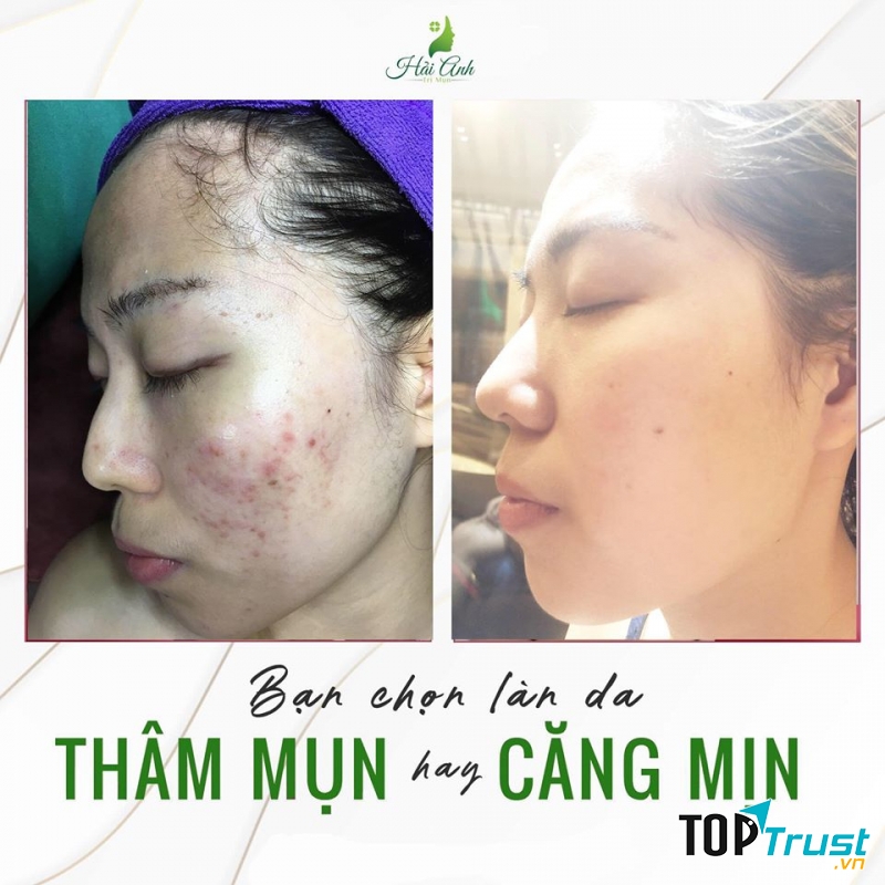 Spa Hải Anh sẽ giúp bạn có gương mặt sạch mụn.