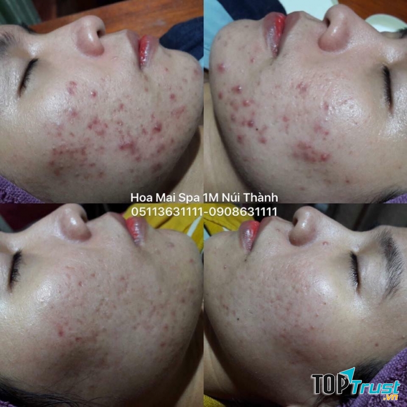 Trước và sau điều trị mụn tại Spa Hoa Mai có sự khác biệt rõ nét