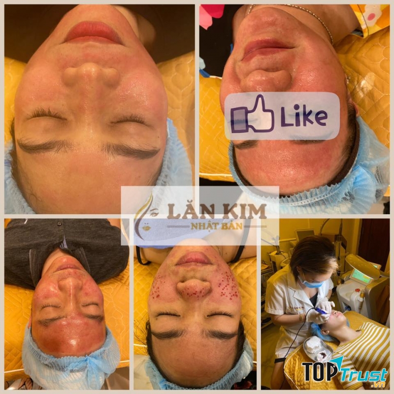 Spa Lăn Kim Nhật Bản