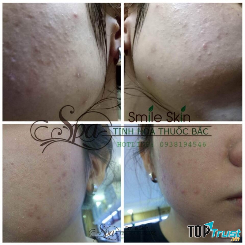 Spa Tinh Hoa Thuốc Bắc SmileSkin