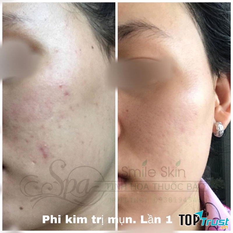 Spa Tinh Hoa Thuốc Bắc SmileSkin