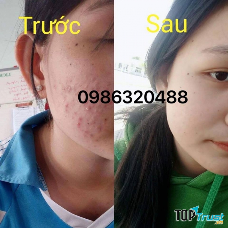 Hình ảnh khách hàng sau khi trị mụn tại Spa VyVy