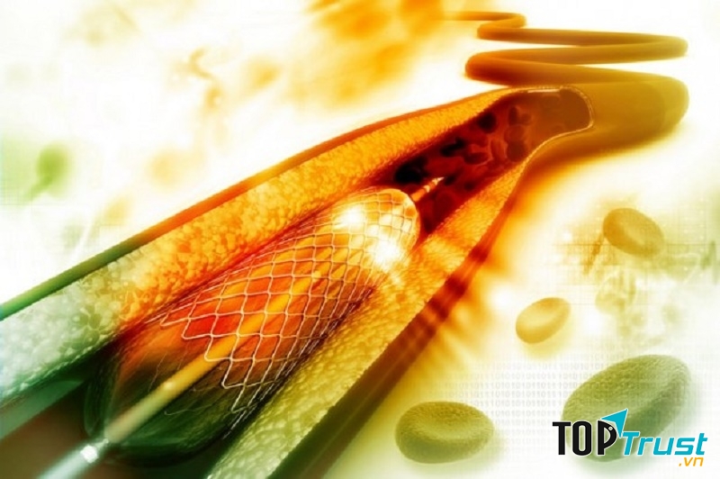 Stent tự tiêu hủy