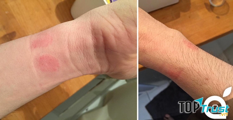 Sử dụng các loại phụ kiện bằng kim loại kém chất lượng