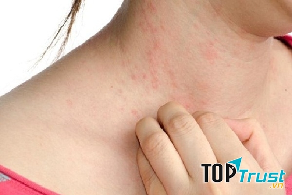 Sử dụng các loại phụ kiện bằng kim loại kém chất lượng