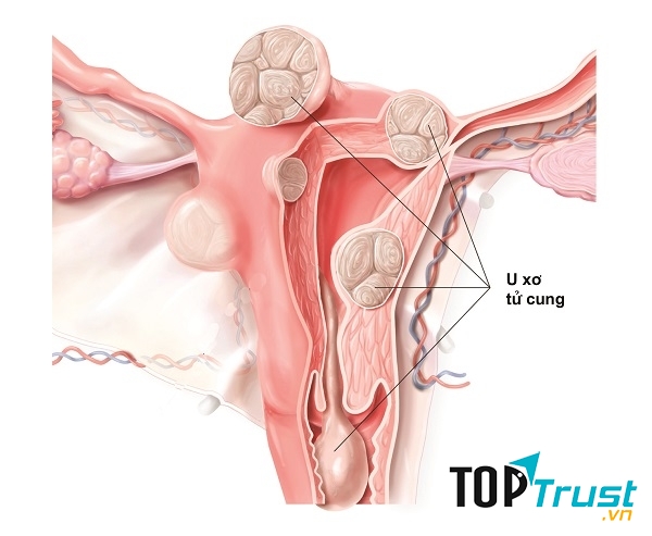 Bệnh U xơ cổ tử cung